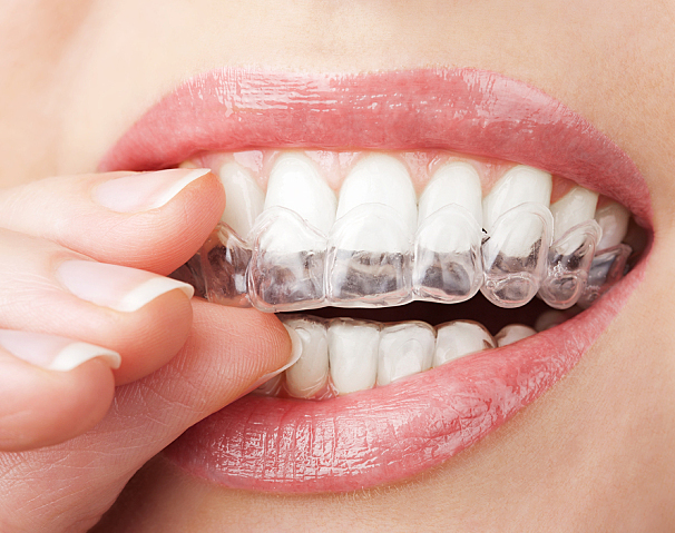 Clear aligners treatment