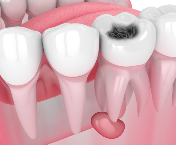 Dental exam and cavity treatment